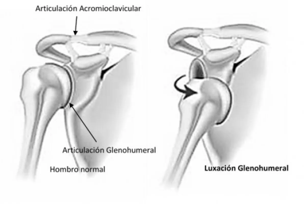 Luxación de hombro. Entrevista al Dr. Eduardo Sánchez Alepuz
