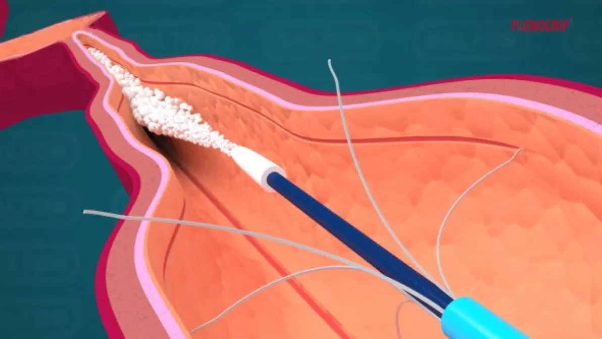 El Hospital IMED Valencia a la vanguardia en el tratamiento de las varices