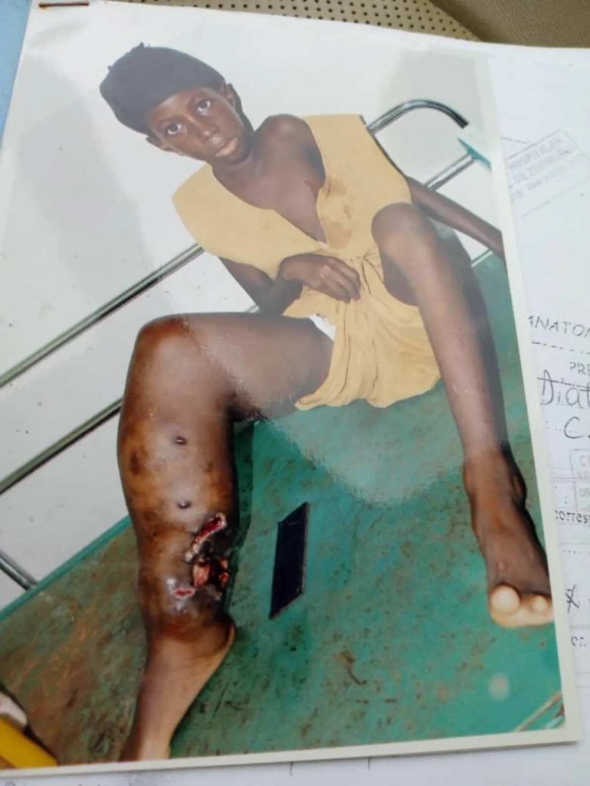 IMED Valencia Hospital diagnosis and treat a rare disease on a Senegalese child