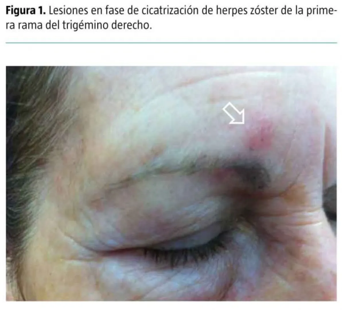 Tratamiento del dolor neuropático con lacosamida